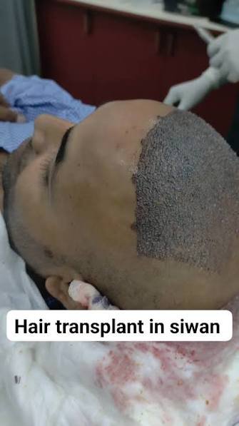 Hair transplant hairline result in Siwan