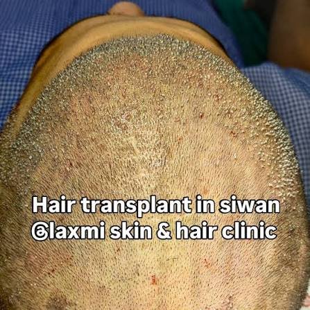 Hair transplant in Siwan @ Laxmi Skin & Hair Clinic