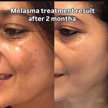 Melasma treatment clinical result after 2 months at Laxmi Skin & Hair Clinic